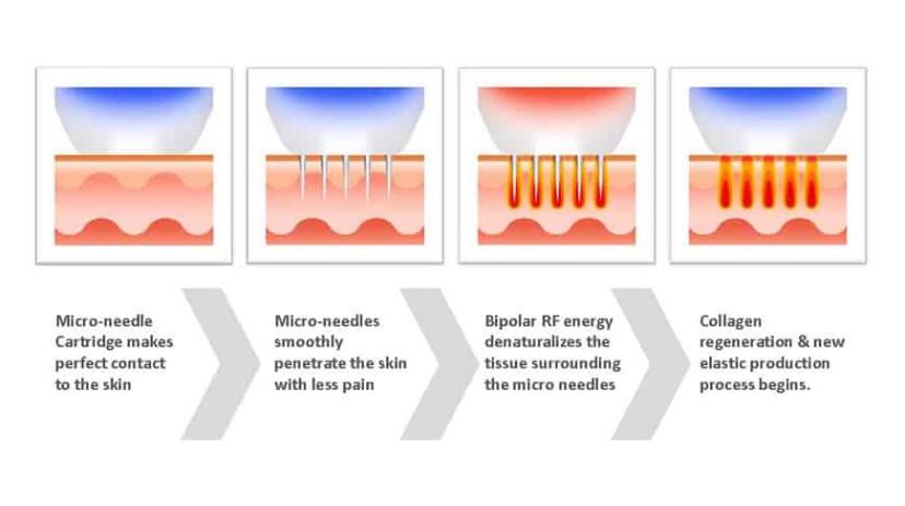 fractional rf how does it work