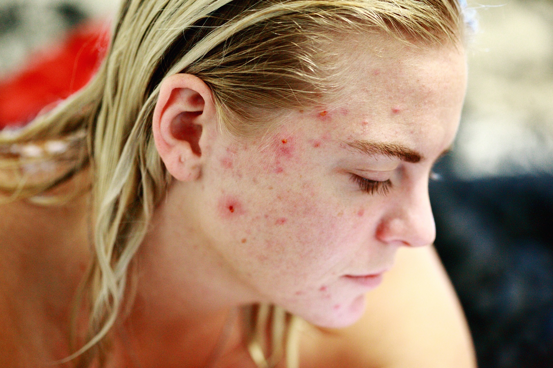 recommendations to clear acne skin