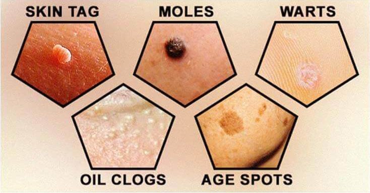 skin tags